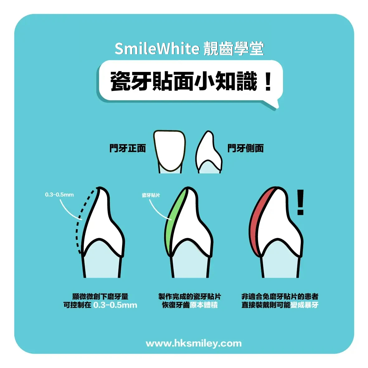 瓷牙貼面小知識:門牙正面與側面示意 —— 顯微微創下磨牙量可控制在 0.3-0.5mm;製作完成的瓷牙貼片恢復牙齒原本體積;非適合免磨牙貼片的患者直接裝戴則可能變成暴牙