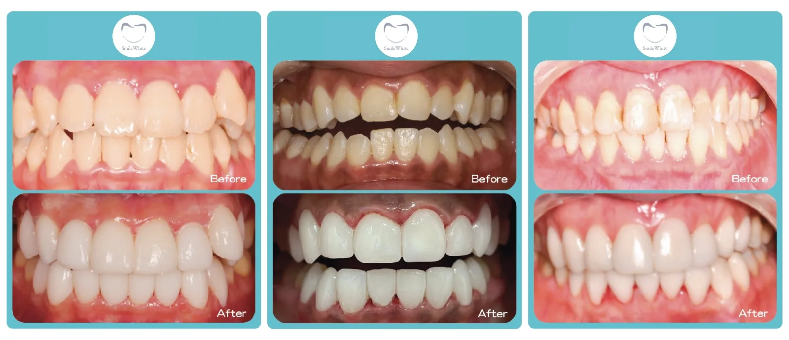 Smile White 全瓷牙貼真實案例 10 — 療程前後對比